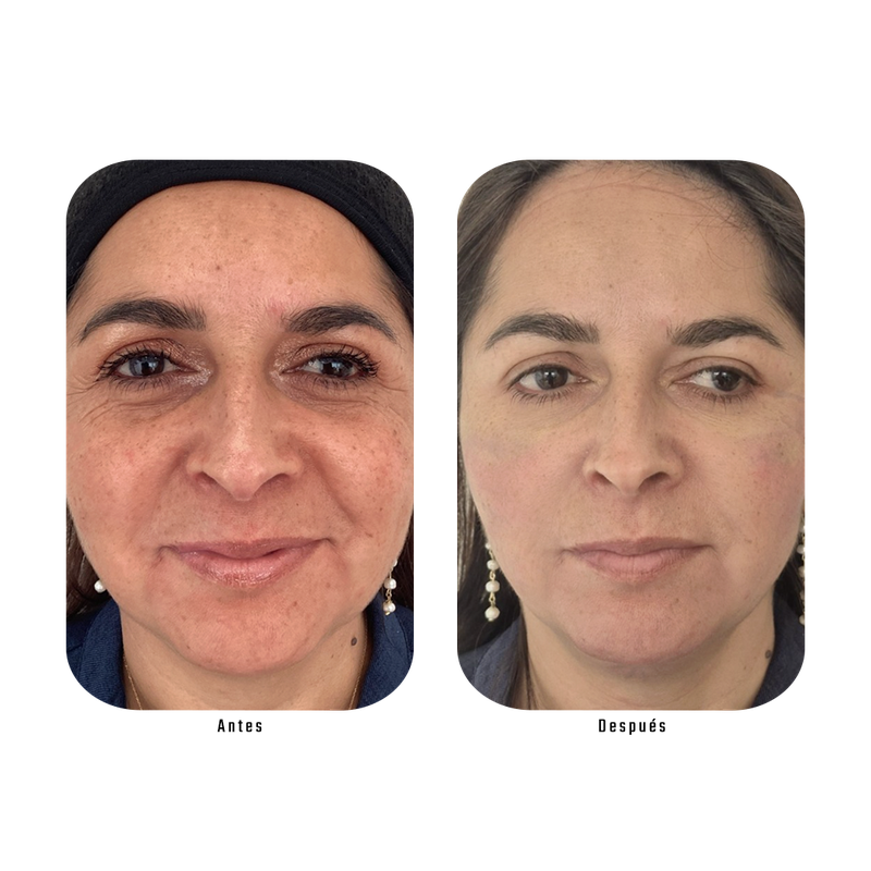 Antes y después Lumina — Luminosidad