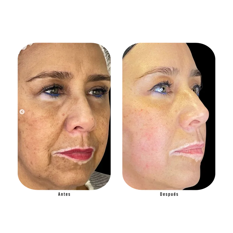 Antes y después de Endolaser facial — Protocolo Lumina