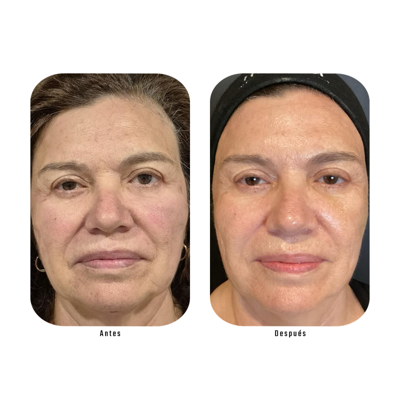 Resultado Lumina — Despigmentación