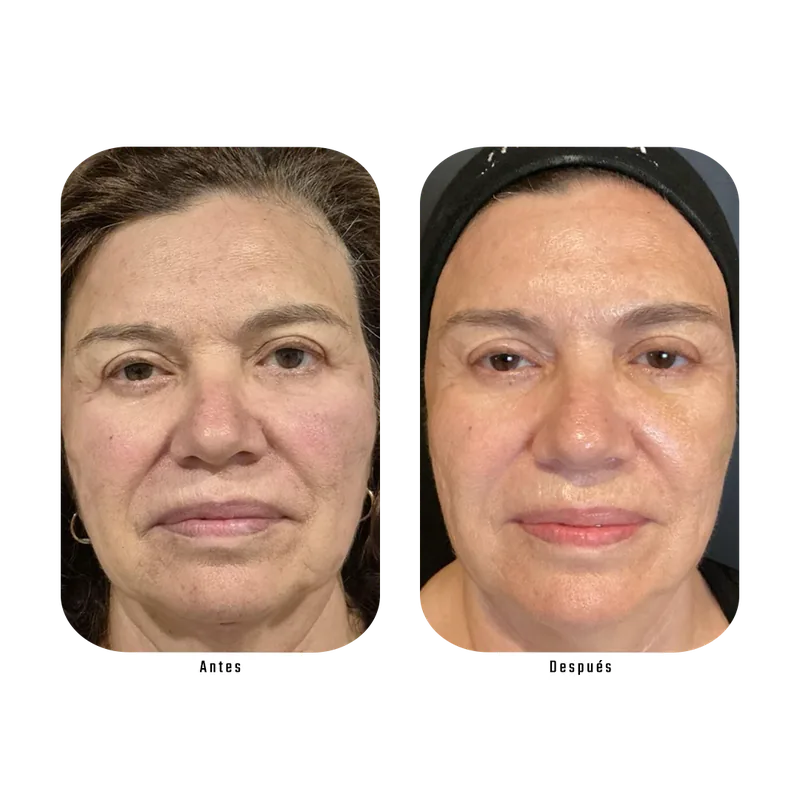 Antes y después de Endolifting facial — Protocolo Lumina