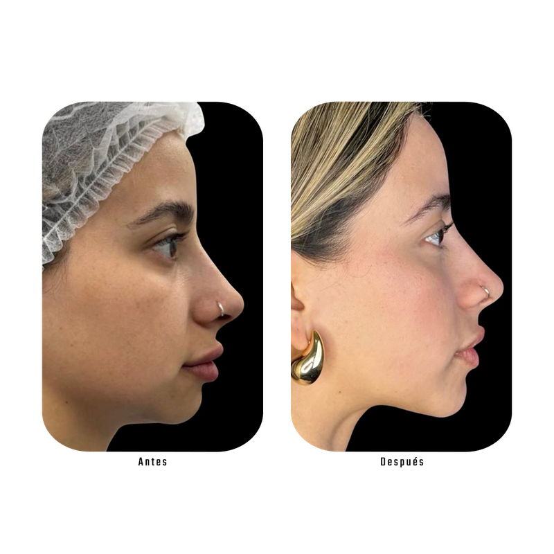 Antes y después Lumina — Textura