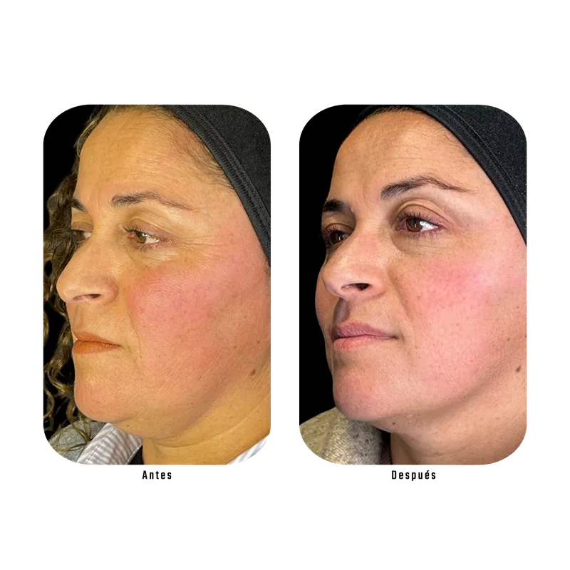 Antes y después de Endojiwoo — Protocolo Lumina