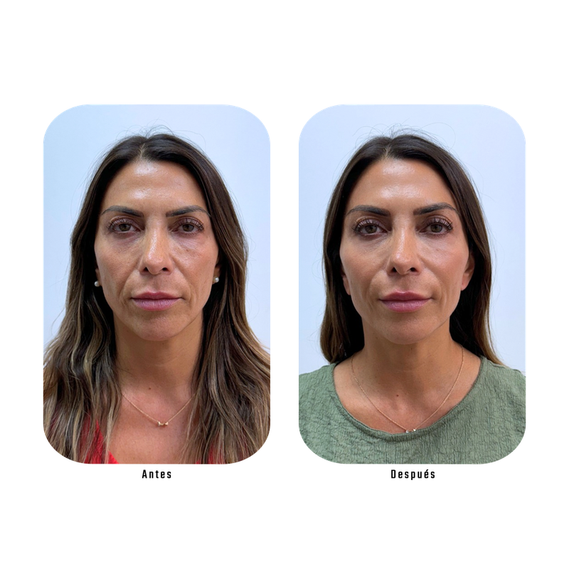 Resultado Lumina — Rejuvenecimiento total