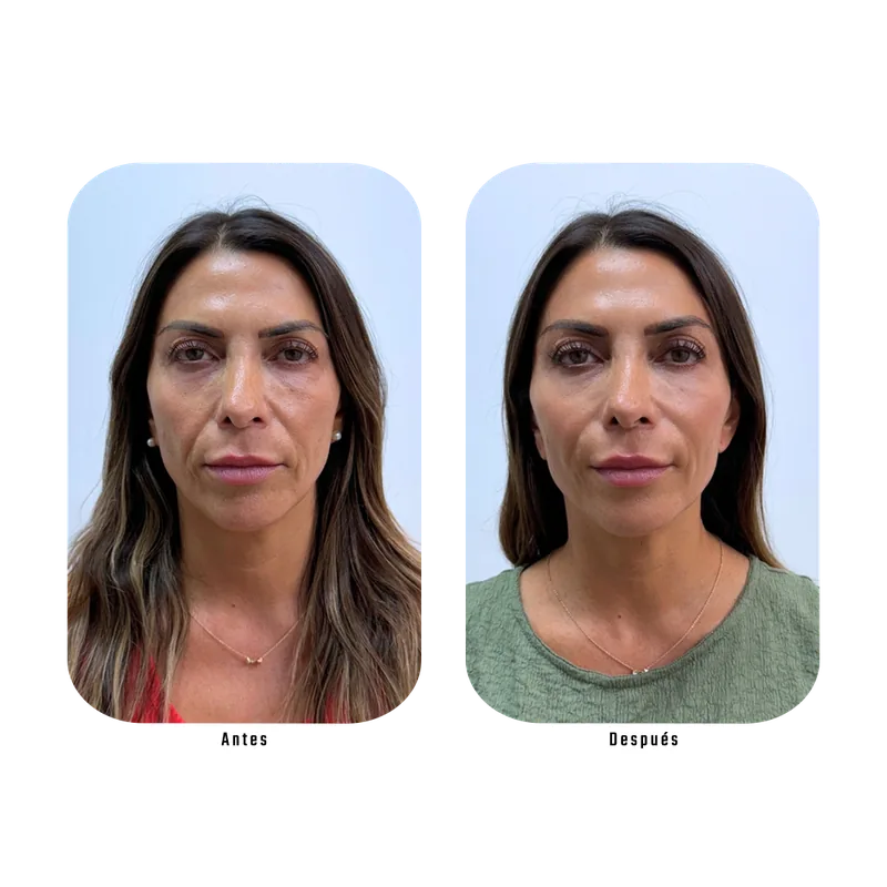 Antes y después de Endolaser facial — Protocolo Lumina