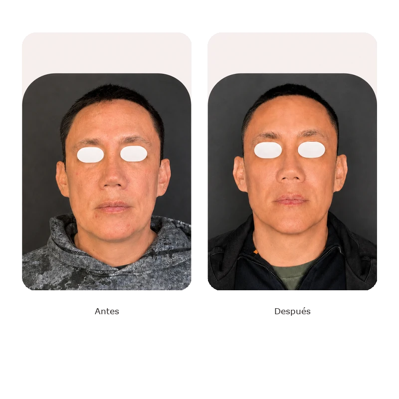 Antes y después Lumina — Lifting facial masculino, tercio medio e inferior