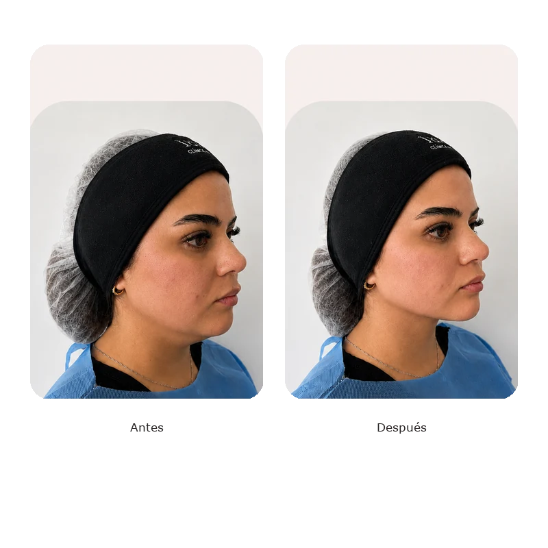 Antes y después Lumina — Lifting facial mujer 35 años, tercio medio e inferior
