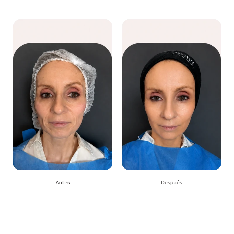 Antes y después Lumina — Lifting tercio medio e inferior, mujer 50+