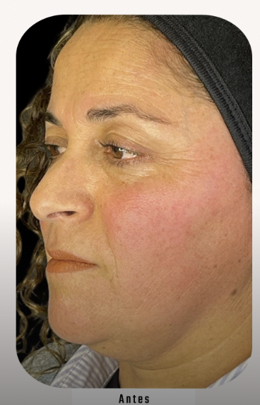 Ana María — Antes del tratamiento Lumina