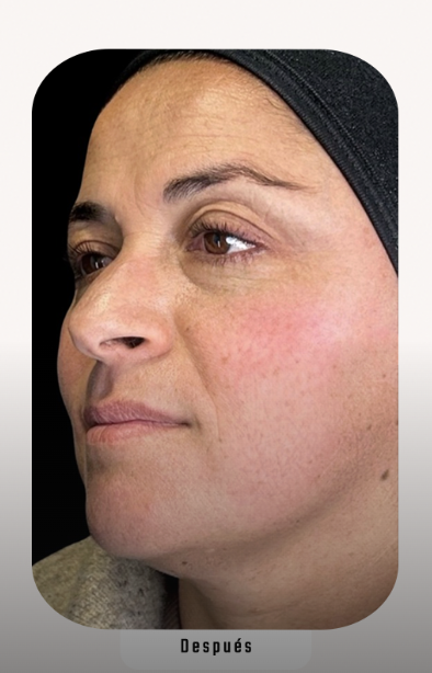 Ana María — Después del tratamiento Lumina