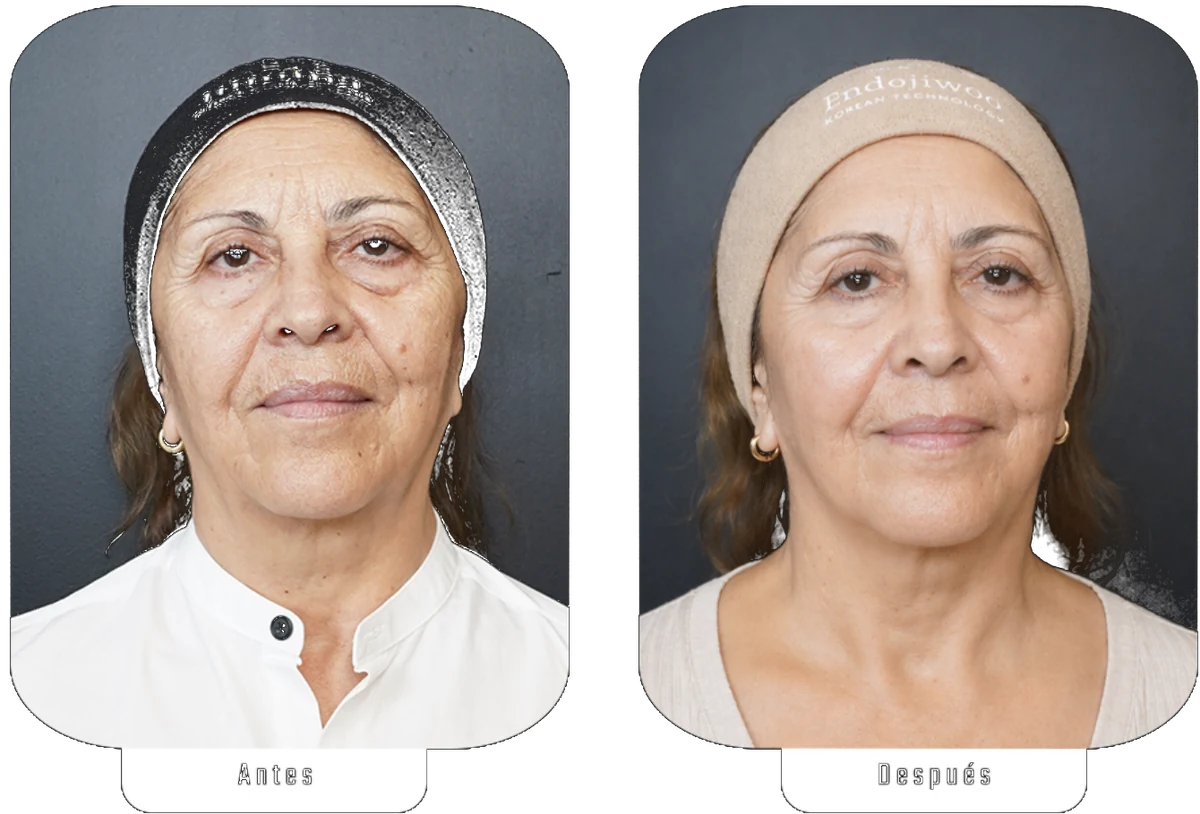 Lurayen Benavides — Caso real Endojiwoo · Protocolo Lumina