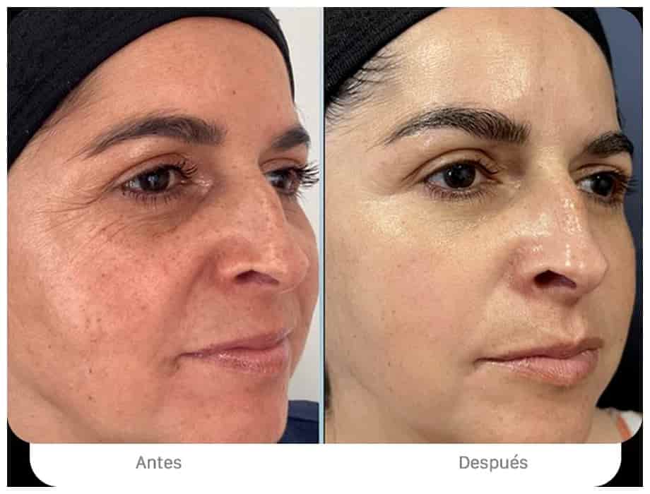 Protocolo Lumina endolaser - luminosidad y textura facial mejorada